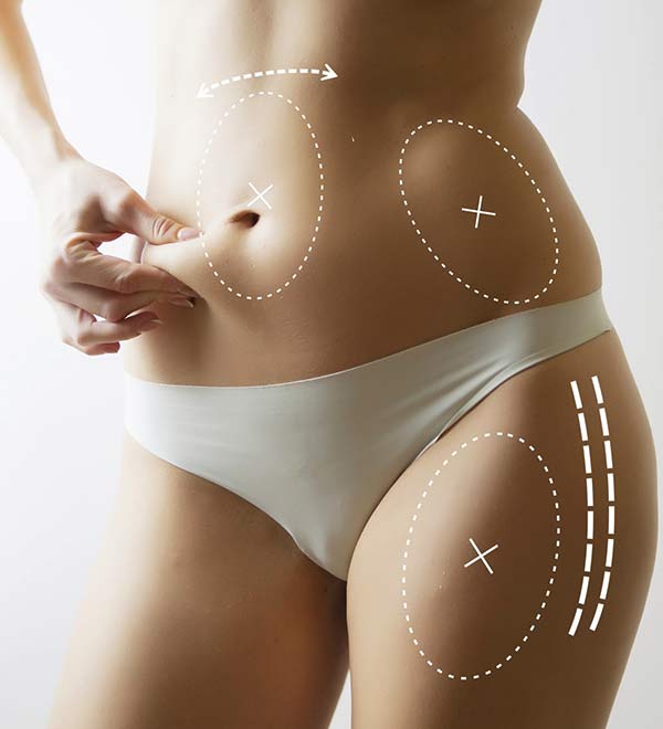 Abdominoplasty in Nagpur