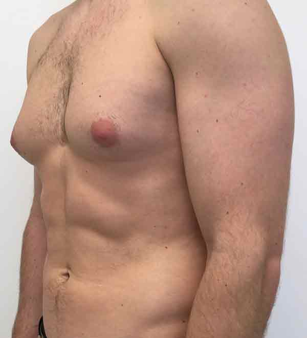 Gynecomastia surgery in Nagpur