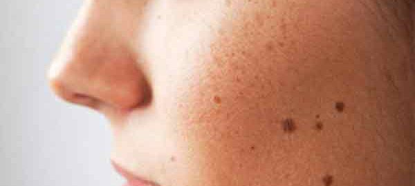 Moles Removal in Nagpur