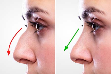 nose reshaping surgery in Nagpur