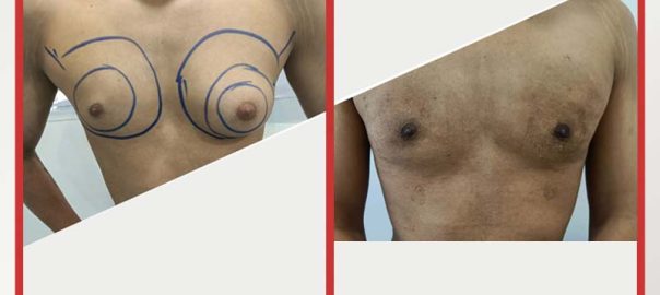 "Before and after treatment photos of a male patient with gynecomastia showing significant improvement." gynecomastia treatment in Nagpur