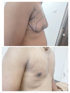 "Before and after photos of a male chest showing gynecomastia treatment results by Dr. Bhupendra in Nagpur. The left photo displays enlarged breast tissue, and the right photo shows a flatter, more masculine chest post-surgery."