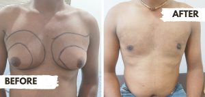 "Before and after comparison images of gynecomastia treatment in Nagpur. The left photo shows a patient with enlarged breast tissue, and the right photo displays the patient after successful surgical correction by Dr. Bhupendra."